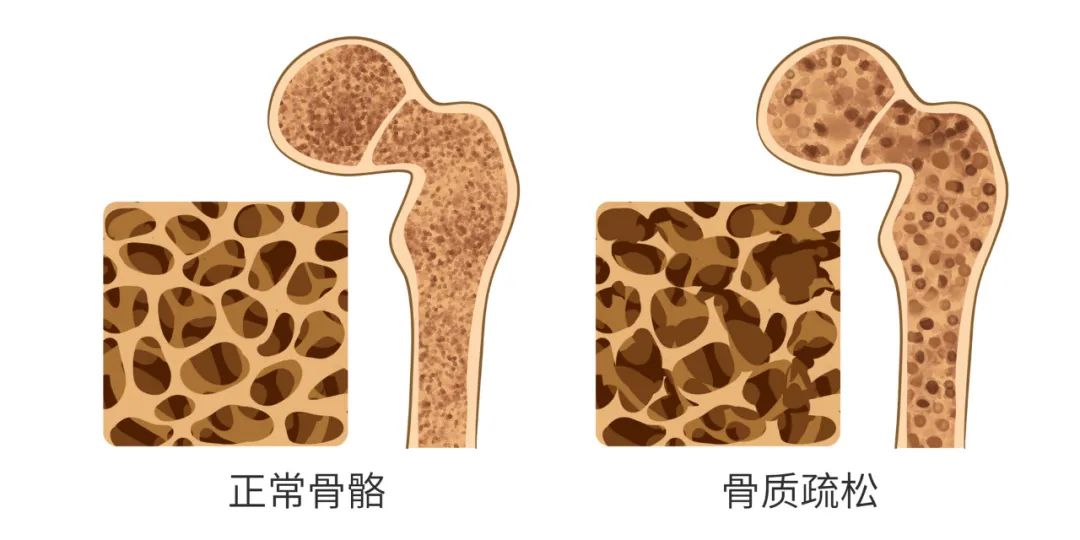 四类人建议做骨密度检查 | 科普时间